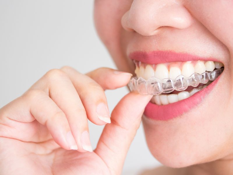 quanto custa o aparelho Invisalign