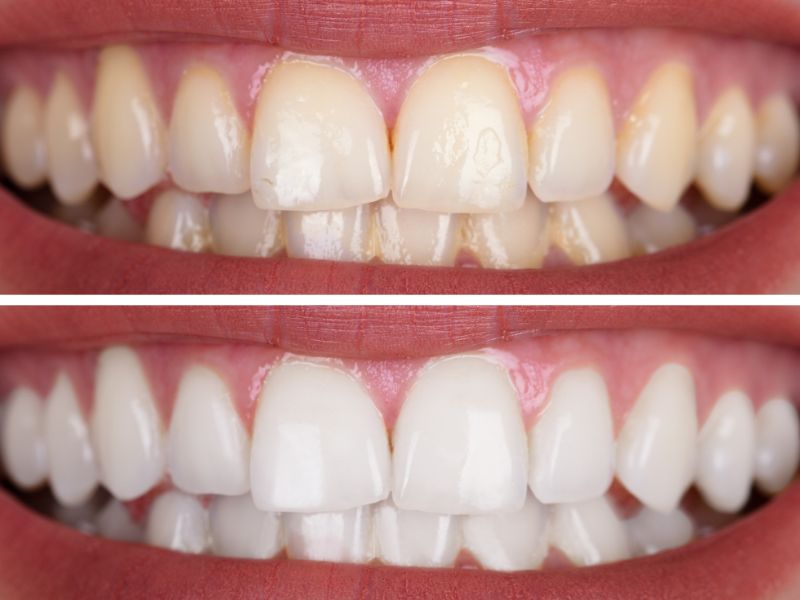 clareamento dental a laser